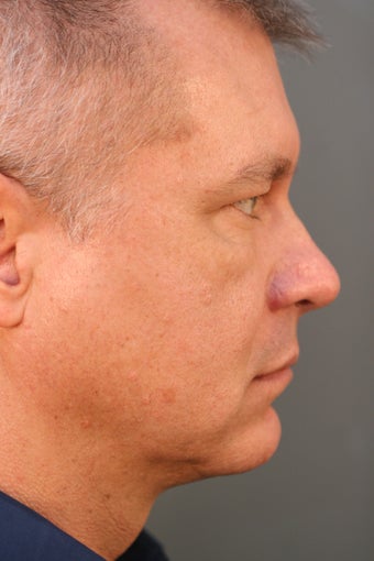 Male Chin Implant after 831525