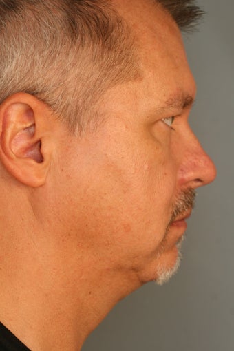 Male Chin Implant before 831525