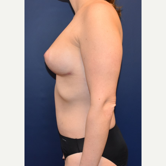 35-44 year old woman treated with Sientra Breast Implants after 3049673