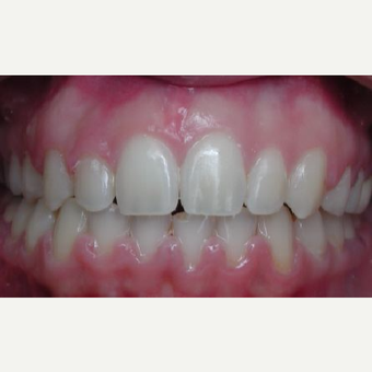 18-24 year old woman treated with Braces after 3658429