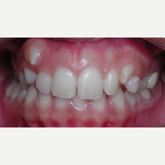18-24 year old woman treated with Braces before 3658429