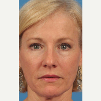 45-54 year old woman treated with Eye Bags Treatment after 3787606