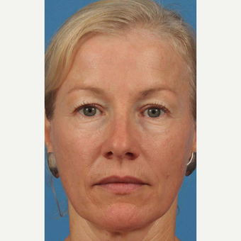 45-54 year old woman treated with Eye Bags Treatment before 3787606