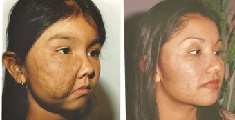 Correction of Cheek Vascular Birthmark with Reverse Facelifts before 1282564