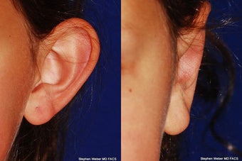 Ear Surgery before 1445758