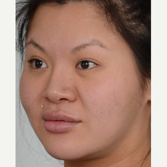 25-34 year old woman treated with Masseter Botox for Jaw Reduction before 2561321