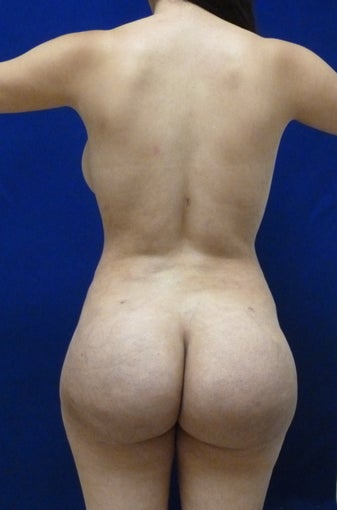 24 y.o. female – Liposuction of abdomen, flanks, and back with fat transfer to buttocks & hips– 900cc per side after 1506165