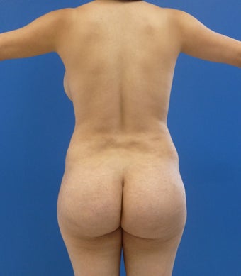 24 y.o. female – Liposuction of abdomen, flanks, and back with fat transfer to buttocks & hips– 900cc per side before 1506165