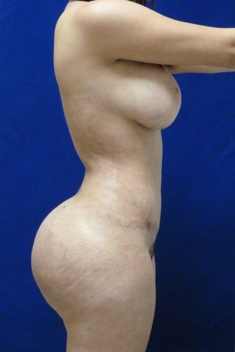 24 y.o. female – Liposuction of abdomen, flanks, and back with fat transfer to buttocks & hips– 900cc per side 1506165