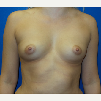 18-24 year old woman treated with Breast Augmentation before 3253844
