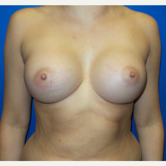 18-24 year old woman treated with Breast Augmentation after 3253844