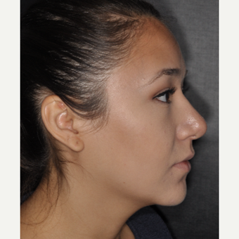 18-24 year old woman treated with Buccal Fat Removal 1 year post-op after 3708674