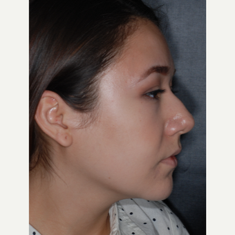 18-24 year old woman treated with Buccal Fat Removal 1 year post-op before 3708674
