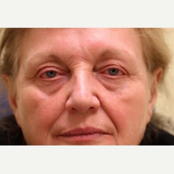 55-64 year old woman treated with injectables only to achieve nonsurgical facelift before 1878681