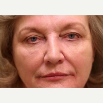 55-64 year old woman treated with injectables only to achieve nonsurgical facelift after 1878681