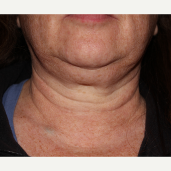 55-64 year old woman treated with 1 treatment Kybella before 3185549
