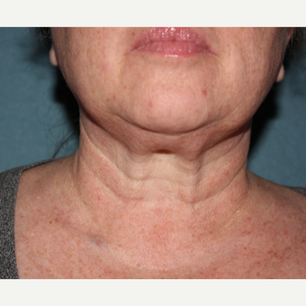 55-64 year old woman treated with 1 treatment Kybella after 3185549