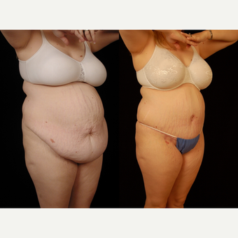 45-54 year old woman treated with Panniculectomy after 3663657