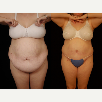 45-54 year old woman treated with Panniculectomy before 3663657