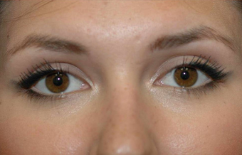 Blepharoplasty after 450145