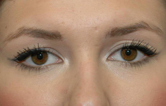 Blepharoplasty before 450145