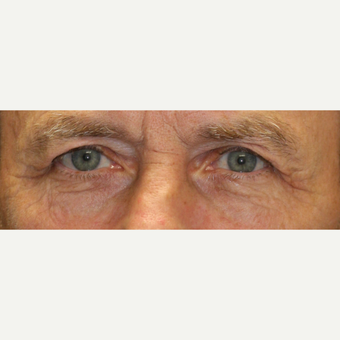 65-74 year old man treated with Injectable Fillers before 3616350
