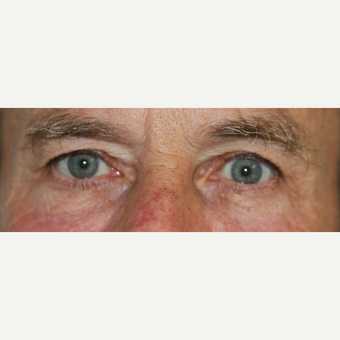 65-74 year old man treated with Injectable Fillers after 3616350