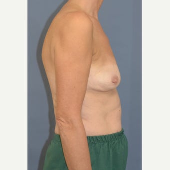 Ruptured Implants and Seroma 1860902