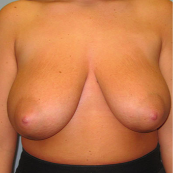 Breast Augmentation before 3467354