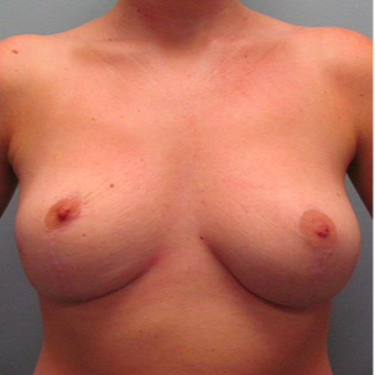 Breast Augmentation after 3467354