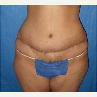 35-44 year old woman treated with Panniculectomy after 3731084