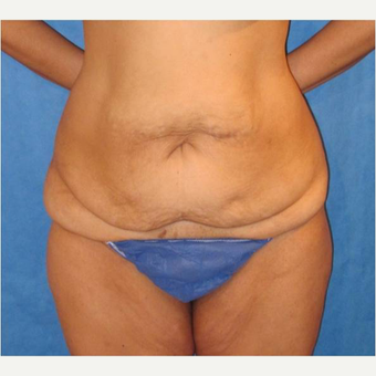 35-44 year old woman treated with Panniculectomy before 3731084