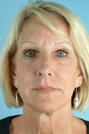 55 Year Old Female Treated for Unwanted Facial Lines after 1016590