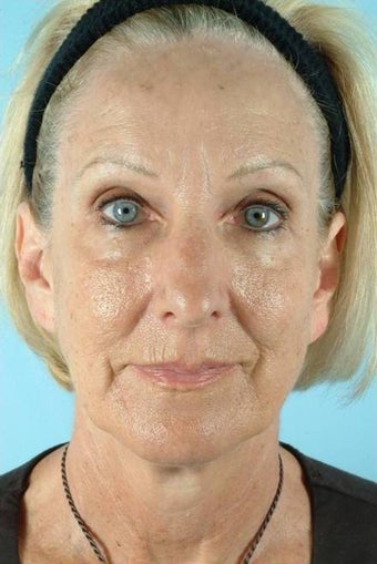 55 Year Old Female Treated for Unwanted Facial Lines before 1016590