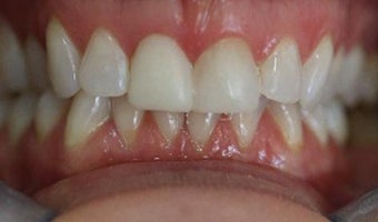 how to whiten and improove your smile with Composite Bonding after 3096978