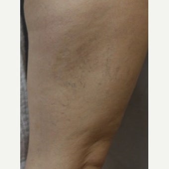 35-44 year old woman treated with Sclerotherapy before 2036988