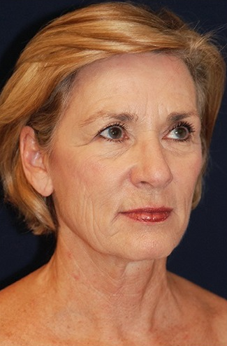 55-64 year old woman treated with Cheek Lift before 1550681