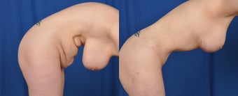 35-44 year old woman treated with Mommy Makeover 3465437