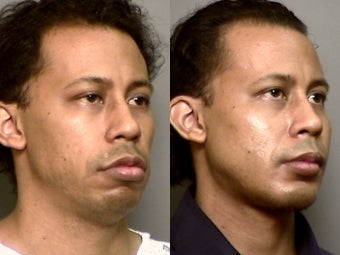 37yr old male with hereditary small chin ,jaw and cheeks before 1429339