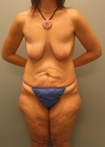 32 year old female who underwent extended adominalplasty, lateriral thighlift, lipo outer thighs, mastopexy, breat augumentation before 1086431