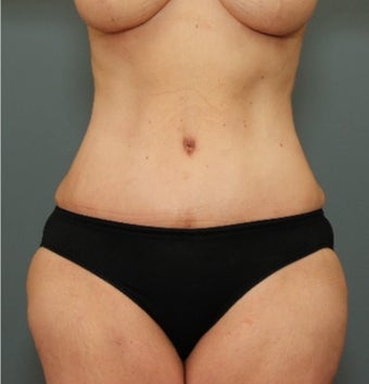45-54 year old woman requesting Tummy Tuck after weight loss after 3070063