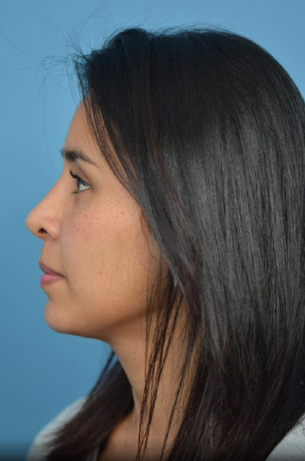 25-34 year old woman treated with Rhinoplasty after 3781482