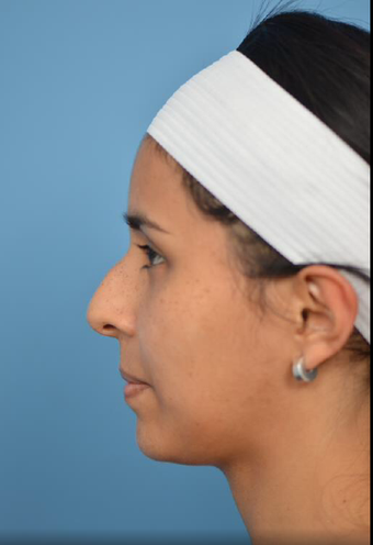 25-34 year old woman treated with Rhinoplasty before 3781482