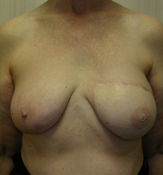 Breast Reconstruction after 1477090