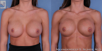 18-24 year old woman treated with Breast Implant Revision before 3768392