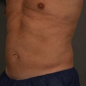 55-64 year old man treated with CoolSculpting 1611919