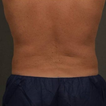 55-64 year old man treated with CoolSculpting after 1611919