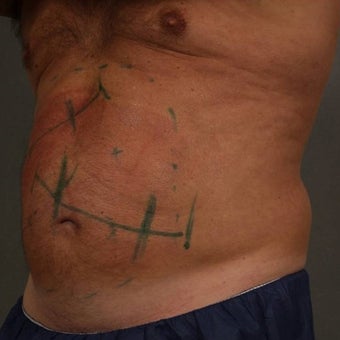 55-64 year old man treated with CoolSculpting 1611919