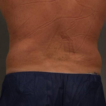 55-64 year old man treated with CoolSculpting before 1611919