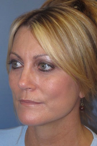 Face Lift/ Lite Lift 940943